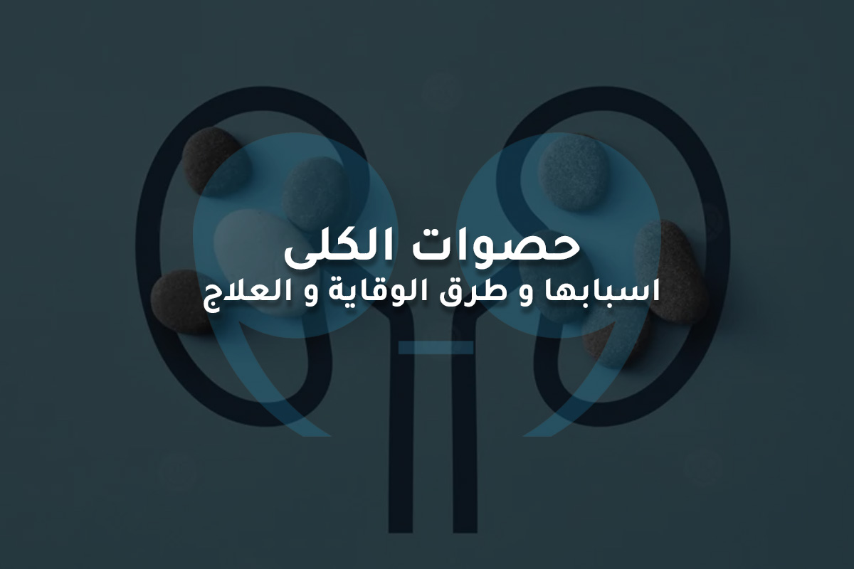 حصوات الكلى اسبابها و طرق الوقاية و العلاج